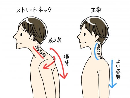 猫背・巻き肩でお困りの方