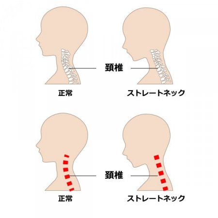 ストレートネックは現代病？